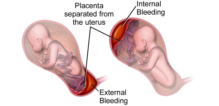 গর্ভাবস্থায় চিন্তিত হবার ৩টি লক্ষণ আপনার জানা আছে কি?