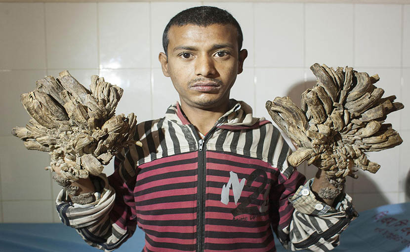 ত্বকের হিউম্যান প্যাপিলোমা ভাইরাস। বৃক্ষ মানব হবার কল্পগল্প!