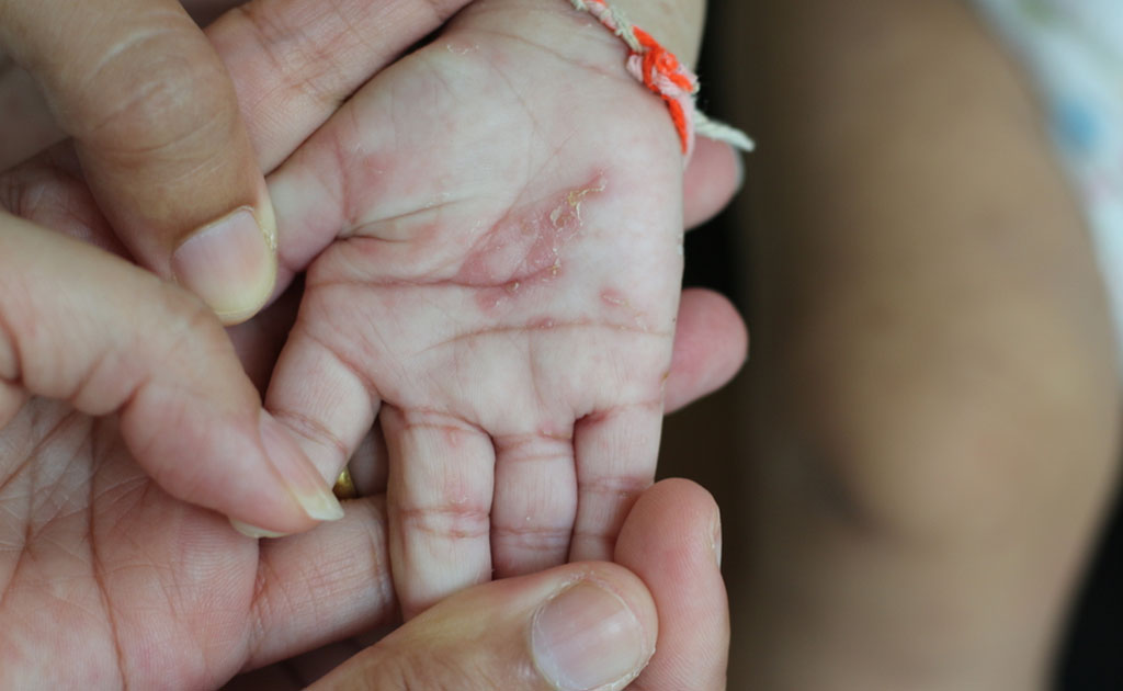 স্ক্যাবিস কী, এর লক্ষণগুলো ও চিকিৎসা কী হতে পারে?