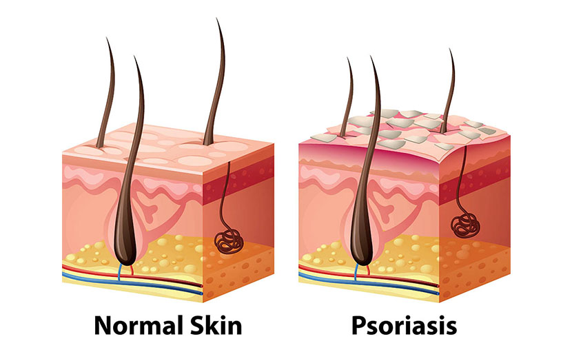 সোরিয়াসিস রোগ হবার কারণ, সংক্রমণের স্থান ও চিকিৎসা সম্পর্কে জানেন কি?