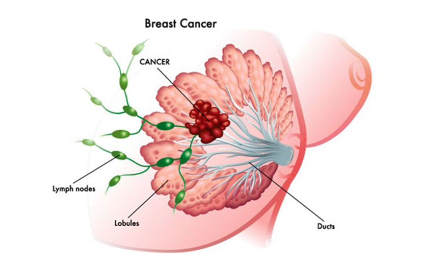স্তনের ক্যান্সার | উপসর্গ, ঝুঁকি ও চিকিৎসা নিয়ে কতটা জানেন?