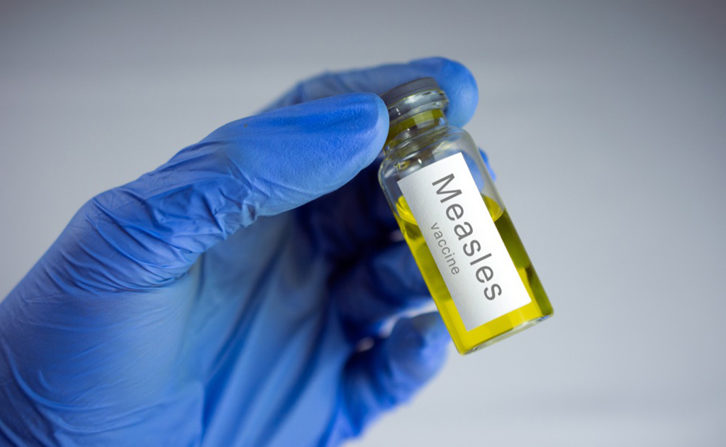 শিশুর হাম হলে পরিণাম কতটা ভয়াবহ হতে পারে এবং এর চিকিৎসা কী?