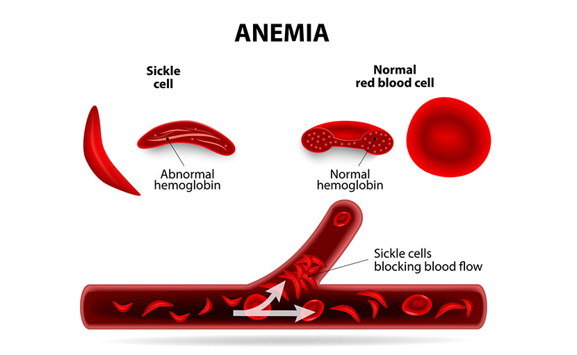রক্তশূন্যতা বা অ্যানিমিয়া | কারণ ও প্রতিরোধে ১২টি খাদ্যাভ্যাস